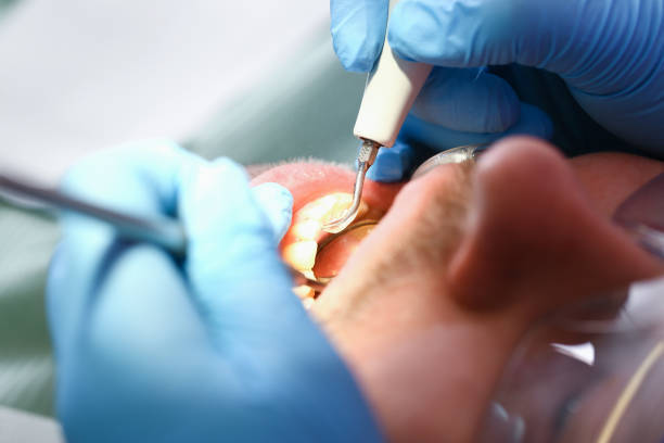 Best Emergency Dental Care for Abscessed Tooth in Mount Vernon, AL
